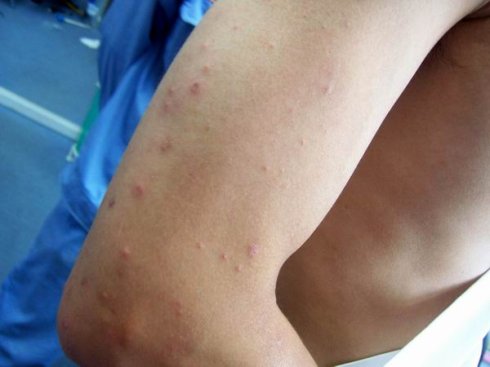 被臭虫药的图片