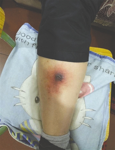 罗先生被虫咬了之后，腿部开始溃烂